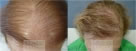 Αποτελέσματα Μεταμόσχευσης Μαλλιών σε γυναίκες